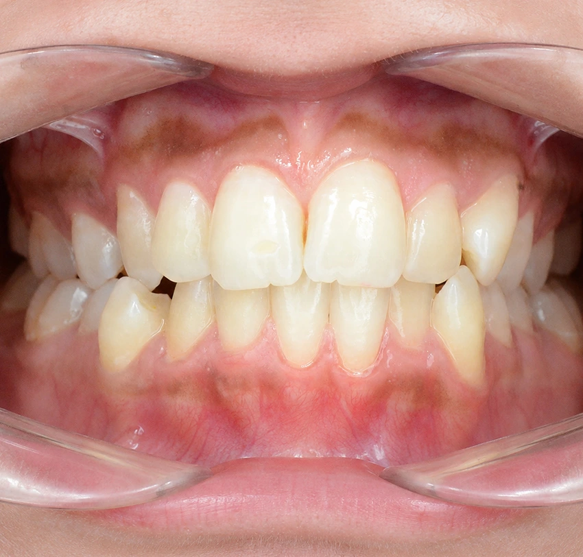 Lower teeth crowding and misalignment before Invisalign treatment at TAM Dental Clinic.