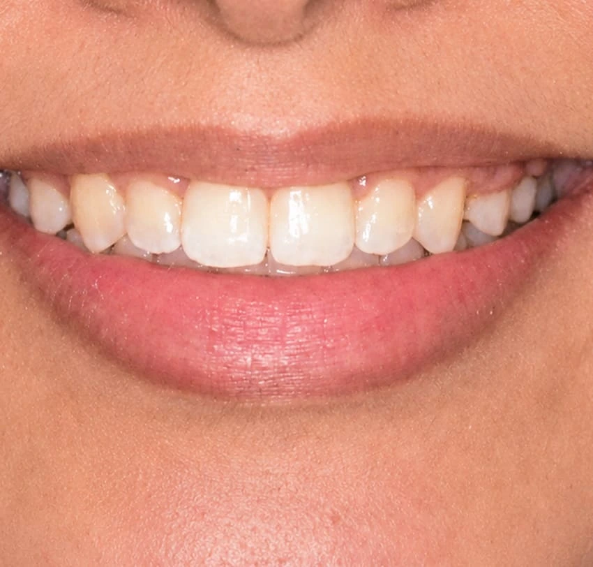 Corrected crossbite and improved tooth alignment after Invisalign treatment at TAM Dental Clinic.