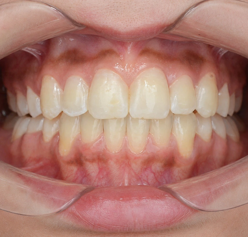 Improved lower teeth alignment and bite after Invisalign treatment at TAM Dental Clinic.