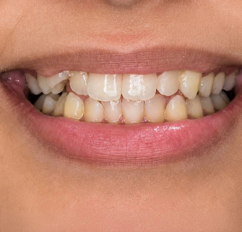 Crossbite and dental misalignment before Invisalign treatment at TAM Dental Clinic.
