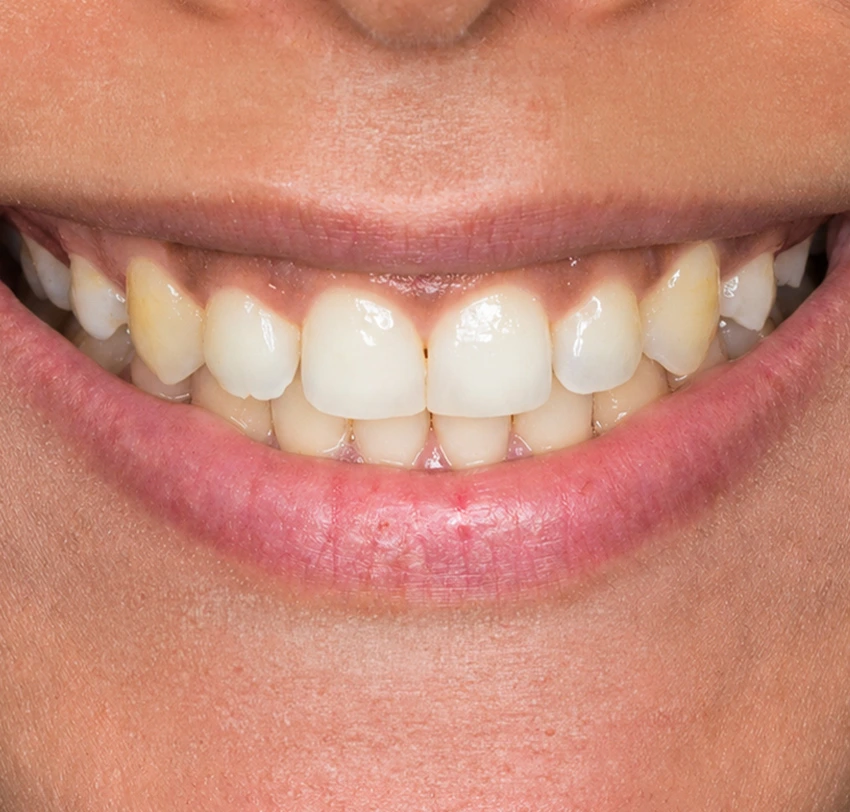 More even, naturally pink gums after gum depigmentation treatment at TAM Dental Clinic.