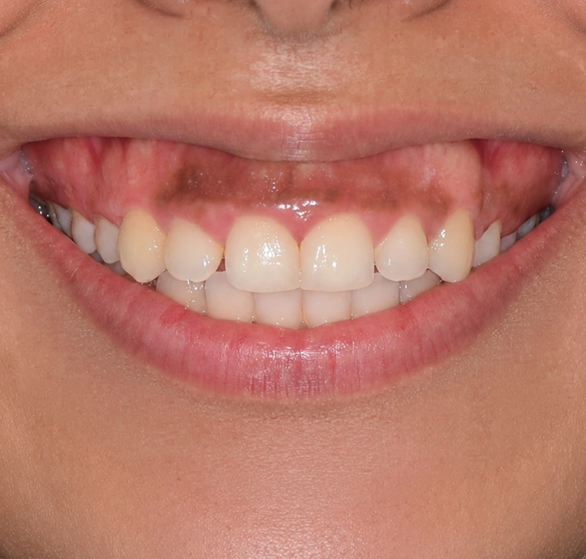 Dark gum pigmentation before gum depigmentation treatment at TAM Dental Clinic.