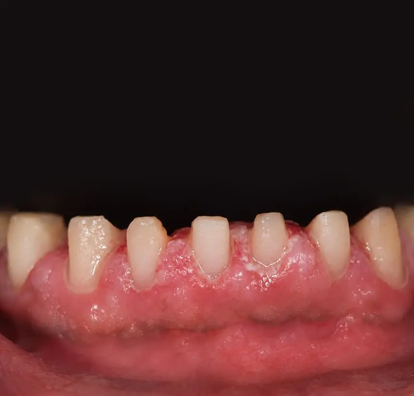 Severely compromised teeth before full-arch zirconia prosthetic treatment at TAM Dental Clinic.