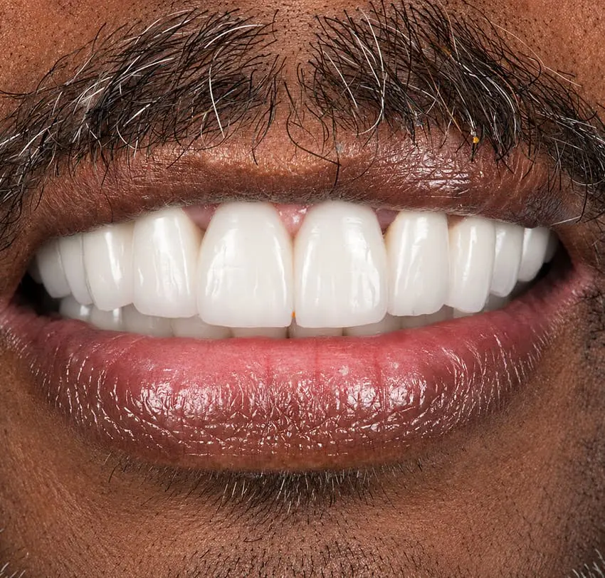 Upper front teeth restored with tooth-supported implant treatment at TAM Dental Clinic.