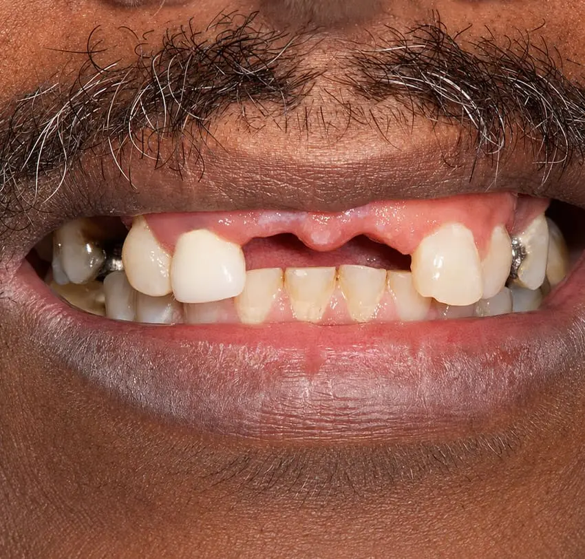 Missing upper front teeth before tooth-supported implant treatment at TAM Dental Clinic.