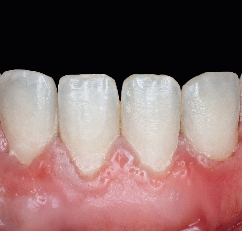 Lower front teeth after soft-tissue grafting, showing increased gum thickness and improved gingival coverage.