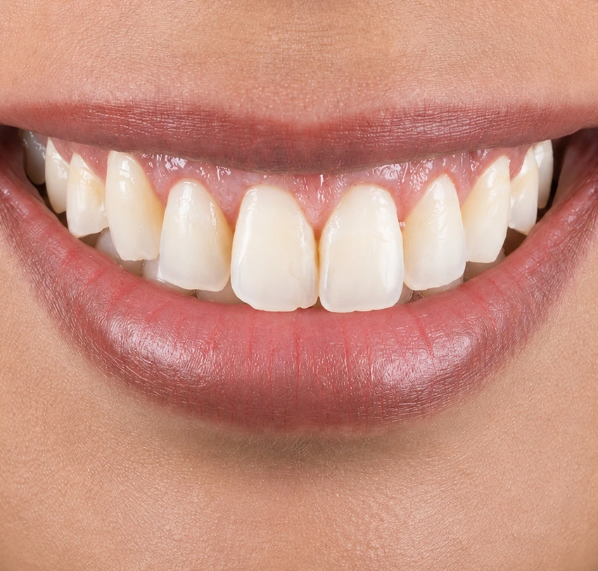 Patient smile after dental treatment at Tam Dental Clinic