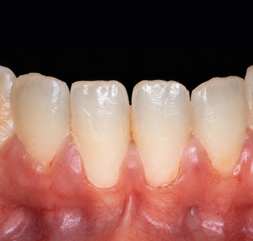 Lower front teeth before gum thickening, showing thin gum tissue and localized gingival recession.