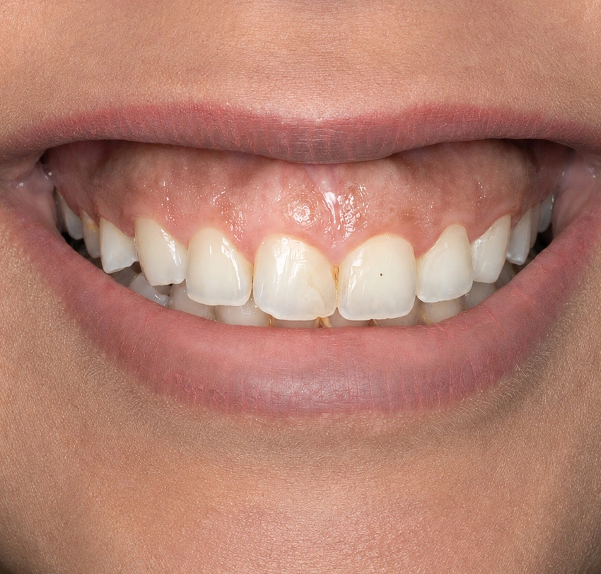 Patient smile before dental treatment at Tam Dental Clinic